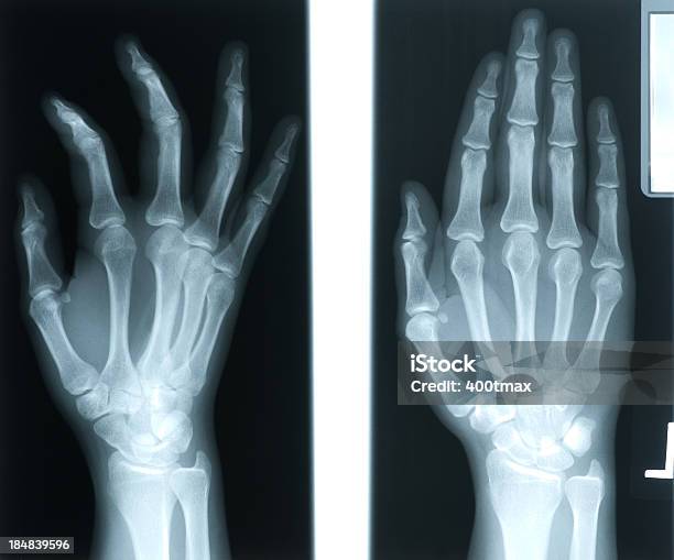 Xray Z Kobieta 24 Lats Prawej Ręce - zdjęcia stockowe i więcej obrazów Złamanie - Złamanie, Śródręcze, Anatomia człowieka