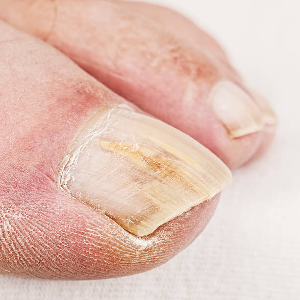 fungo unghia del piede - podiatrist pedicure human foot toenail foto e immagini stock