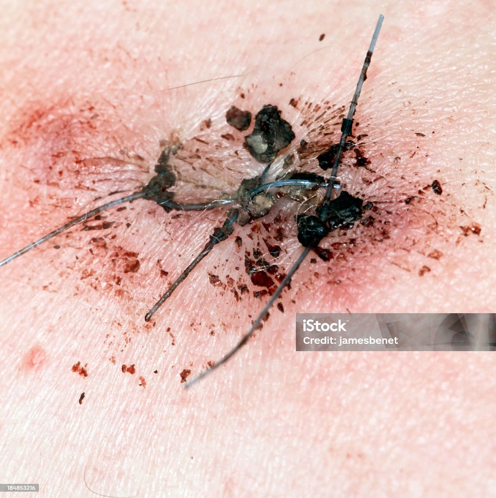 Mole Removal Stage Two "Dermatology procedure for melanoma suspicious mole removal. Second Stage of three, Three large stitches remain from the extraction procedure. See below for other stages.Stage1" Cancer - Illness Stock Photo