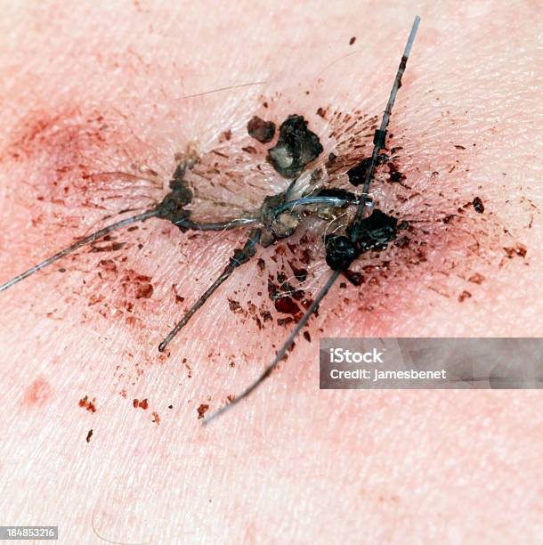 Mole Removal Stage Two Stock Photo - Download Image Now - Cancer - Illness, Concepts, Dermatology