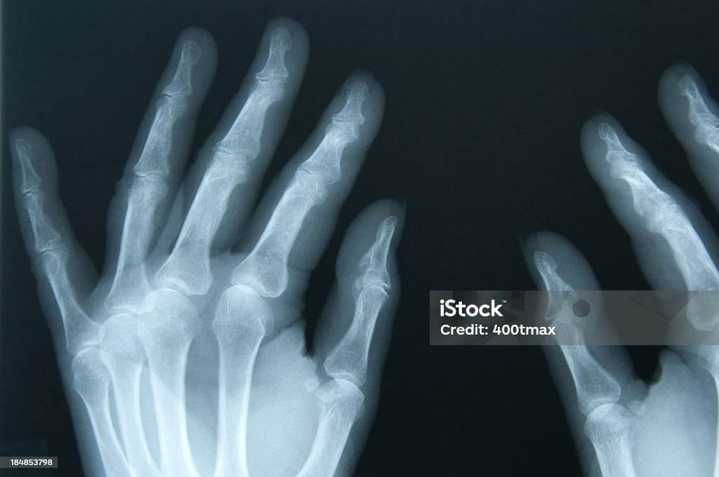 Mujer manos de rayos x de los 65 años de edad - Foto de stock de Artritis libre de derechos