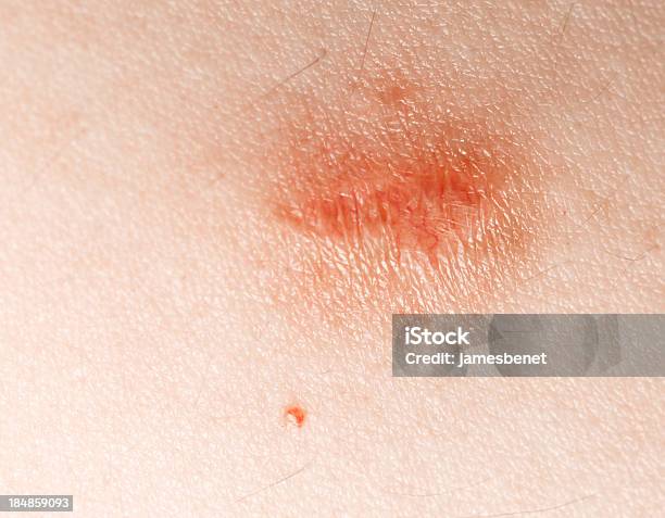 Mole Removal Stage Three Stock Photo - Download Image Now - Melanoma, Scar, Freckle