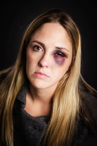 istock Woman with a Black Eye 184866227