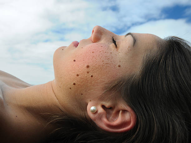 Woman with Melanoma Moles and Freckles sunbathing (XXXL) Portrait of a Woman with Melanoma Moles and Freckles sunbathing at the Beach. Nikon D3X. Converted from RAW (XXXL) mole skin stock pictures, royalty-free photos & images