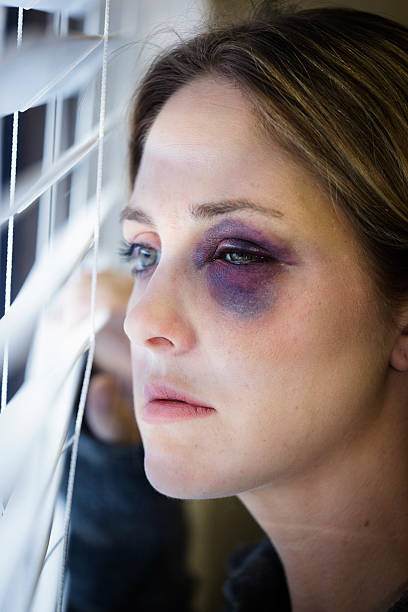 istock Woman with a Black Eye 184870415