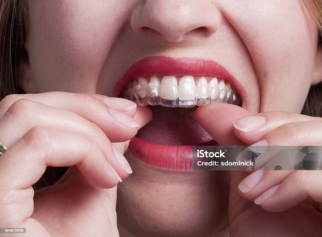 Frau Putting Kunststoff Dental auf Vorschussbasis auf putzen - Lizenzfrei Zahnschiene Stock-Foto
