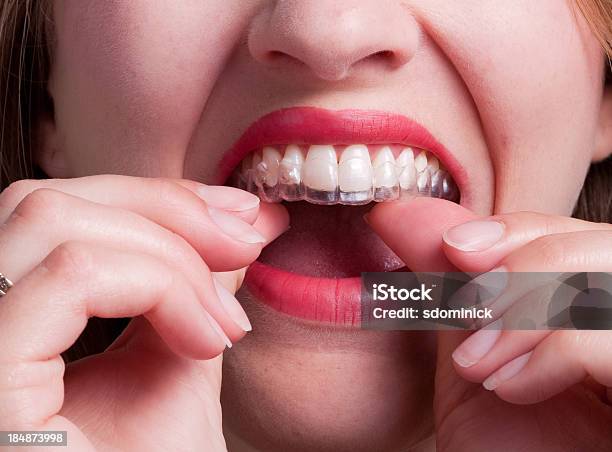 Frau Putting Kunststoff Dental Auf Vorschussbasis Auf Putzen Stockfoto und mehr Bilder von Zahnschiene