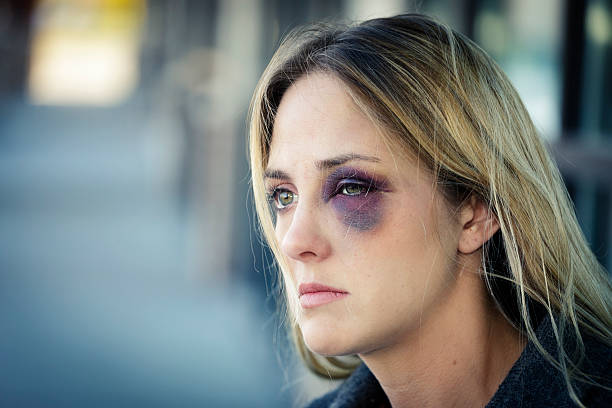 mujer con un ojo negro - cardenal lesión física fotografías e imágenes de stock