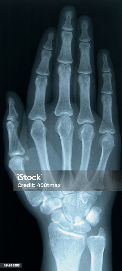 X-ray di 24 anni di mano femmina - Foto stock royalty-free di Cartilagine