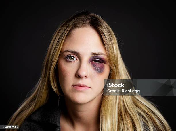 Donna Con Un Occhio Nero - Fotografie stock e altre immagini di Viso - Viso, Livido, Donne