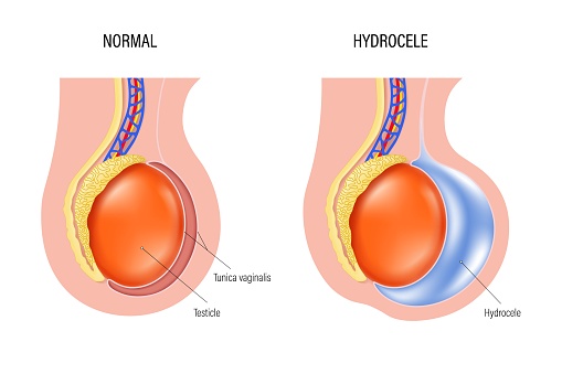 Hydrocele is a swelling of the scrotum. Fluid accumulates in cavity that surrounds testicles. Testicular disease. male reproductive system.