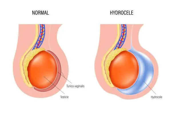 Vector illustration of Hydrocele is a swelling of the scrotum. Fluid accumulates in cavity that surrounds testicles. Testicular disease. male reproductive system.
