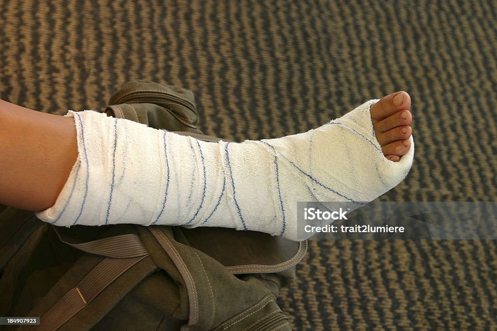 Сломанная нога - Стоковые фото Гипсовая повязка роялти-фри