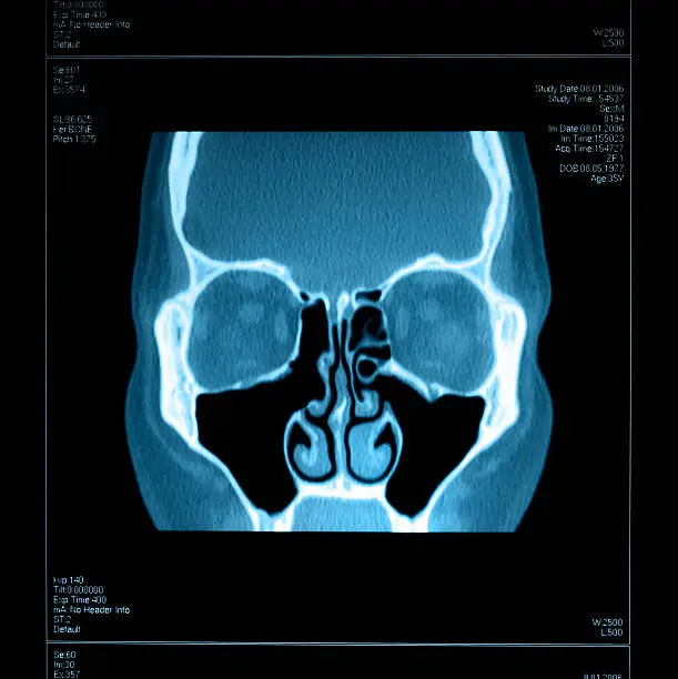 "CT-Scan of the Sinus, this is a photo of a large film negative, so there is slight visible dust and grain."