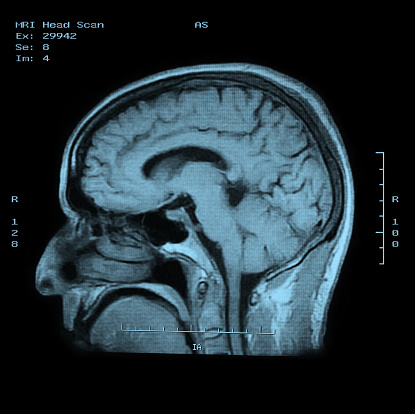 MRI de vista lateral de cabezal de barrido photo