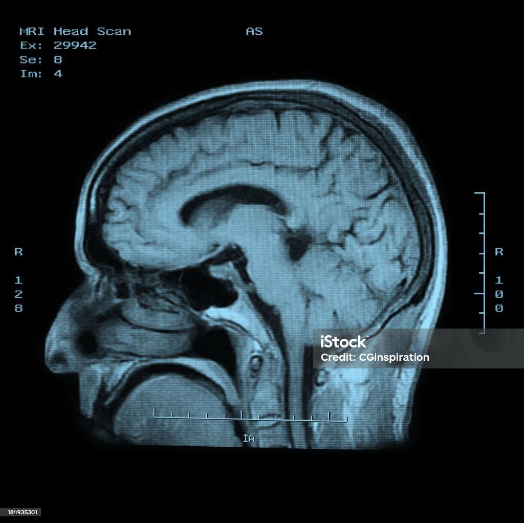 MRI de vista lateral de cabezal de barrido - Foto de stock de Imagen de rayos X libre de derechos