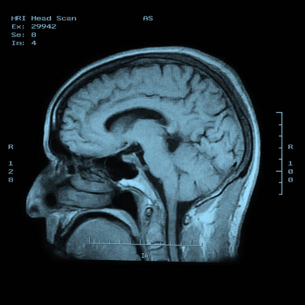 머리 mri 스캔 측면 보기 - mri scan radiologist cat scan cat scan machine 뉴스 사진 이미지