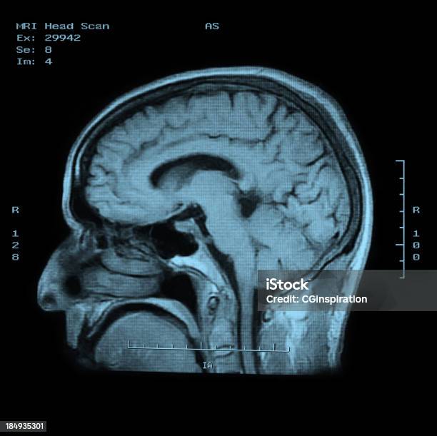 Mri Skanowania Głowy Widok Z Boku - zdjęcia stockowe i więcej obrazów Zdjęcie rentgenowskie - Zdjęcie rentgenowskie, Obrazowanie magnetyczno-rezonansowe, Diagnostyka obrazowa