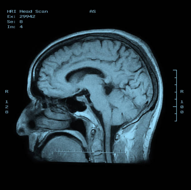 mri head scan side view - brain scan' bildbanksfoton och bilder