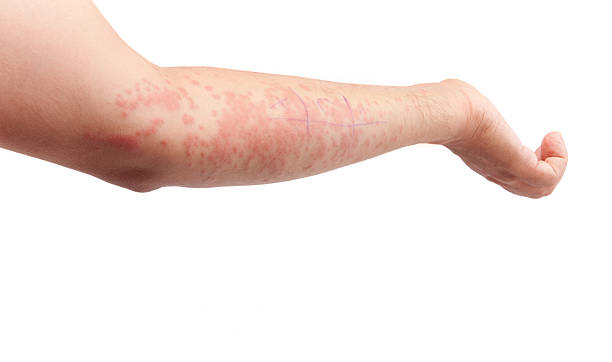 肌のアレルギー - angioedema ストックフォトと画像