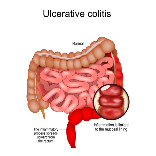 Colitis Diet Mayo Clinic Review: A Powerful Guide to Digestive Wellness