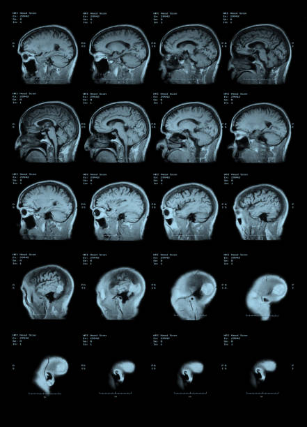 boční zobrazení mri head scanu - bolest-hlavy-ilustrace - stock snímky, obrázky a fotky