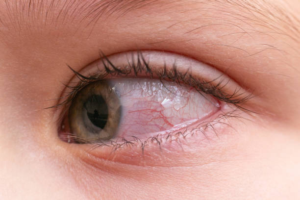근접 촬영 염증 감염 된 빨간 눈 충 혈, 결막염 - conjunctivitis sore eyes child human eye 뉴스 사진 이미지