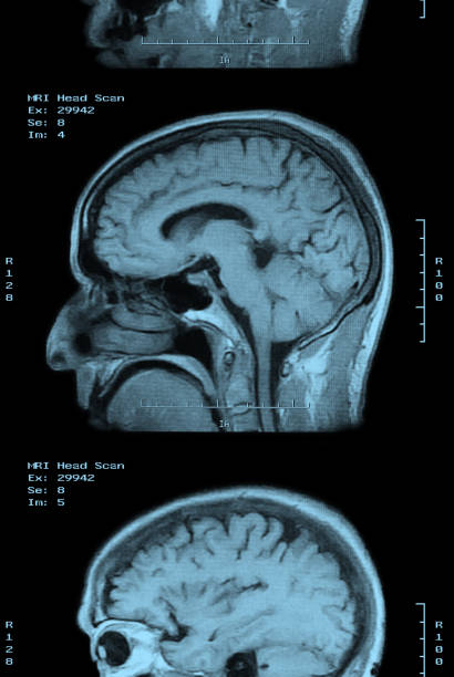mri sken filmový proužek - bolest-hlavy-ilustrace - stock snímky, obrázky a fotky