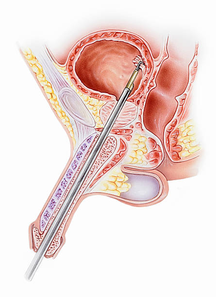 Penis - with Resectoscope "Penis with a resectoscope instrument inserted, cutaway cross section. Shown are the corpus cavemosum, prostate gland, testis, scrotum, anus, rectum, ureteral orifice, urinary bladder, and pubic bone." male reproductive system cross section stock illustrations