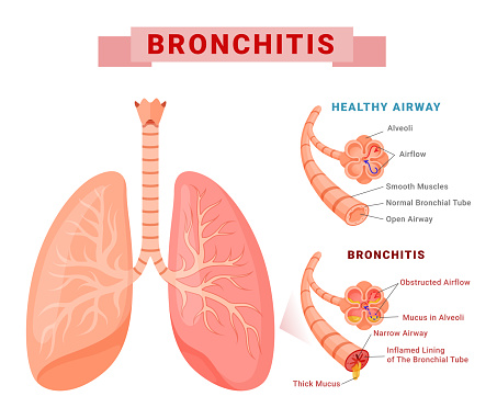 Bronchitis and healthy airway structure infographic medical education scheme banner isometric vector illustration. Normal and unwell bronchial tube anatomical inflammation respiration health care