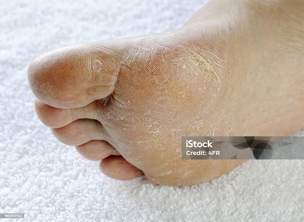 Dry rough Fuß (XXXL - Lizenzfrei Ausgedörrt Stock-Foto