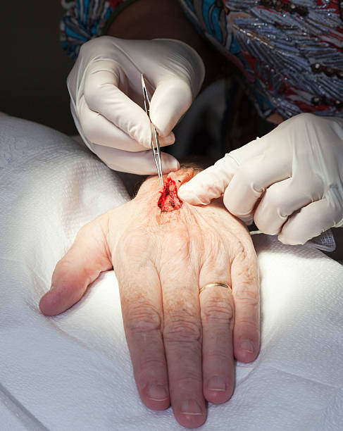 Mohs Surgery Technique Mohs surgery tecnique being performed by surgeon. Doctor tests flexibility of a removed area of skin. The removed skin will be biopsied for the spread of melanoma.  You can see the hand's veins and tissue under the skin. This surgical technique is perfomed by specialits in dermatology. ring tilt stock pictures, royalty-free photos & images