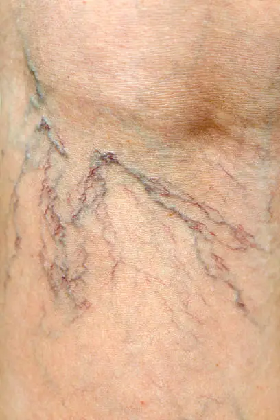 Photo of Close-up of Human Spider Veins on Leg