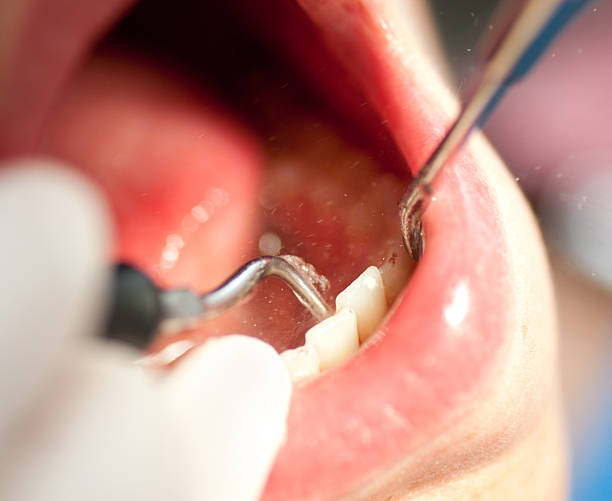 istock at the dentist dental calculus removal - Zahnsteinentfernung 185006693