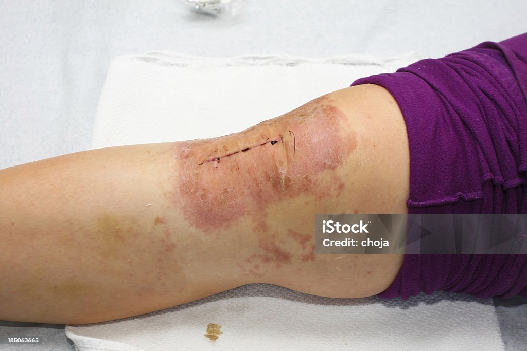 Enfermeiro Mudança de faixa para um paciente após joelho operação - Foto de stock de Alergia royalty-free