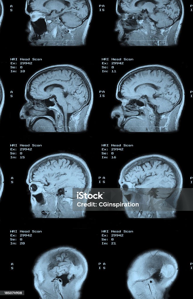 MRI Head Scan Anatomy Stock Photo