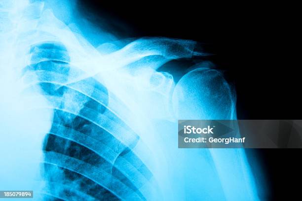 Macho Do Ombro - Fotografias de stock e mais imagens de Imagem de raios X - Imagem de raios X, Anatomia, Articulação - Parte do corpo