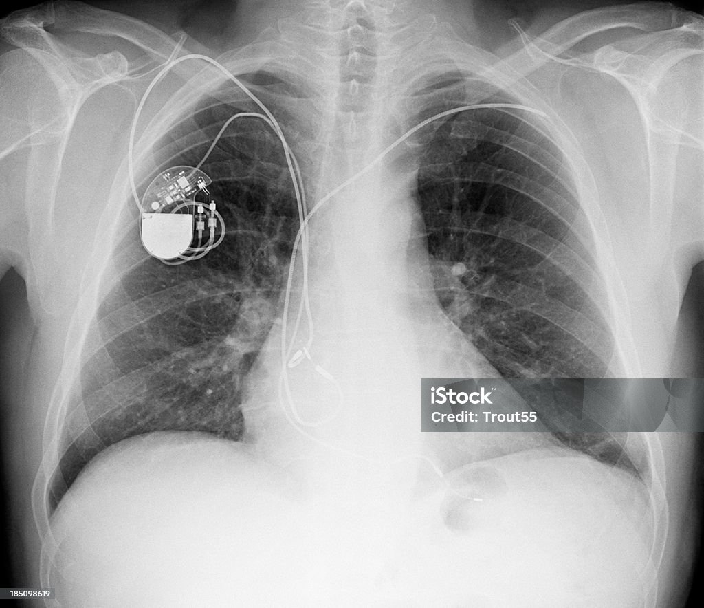 X-ray cadre de la poitrine avec un stimulateur cardiaque - Photo de Stimulateur cardiaque libre de droits