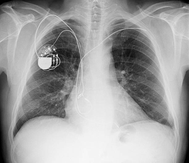 immagine a raggi x del torace con pacemaker - rib cage people x ray image x ray foto e immagini stock
