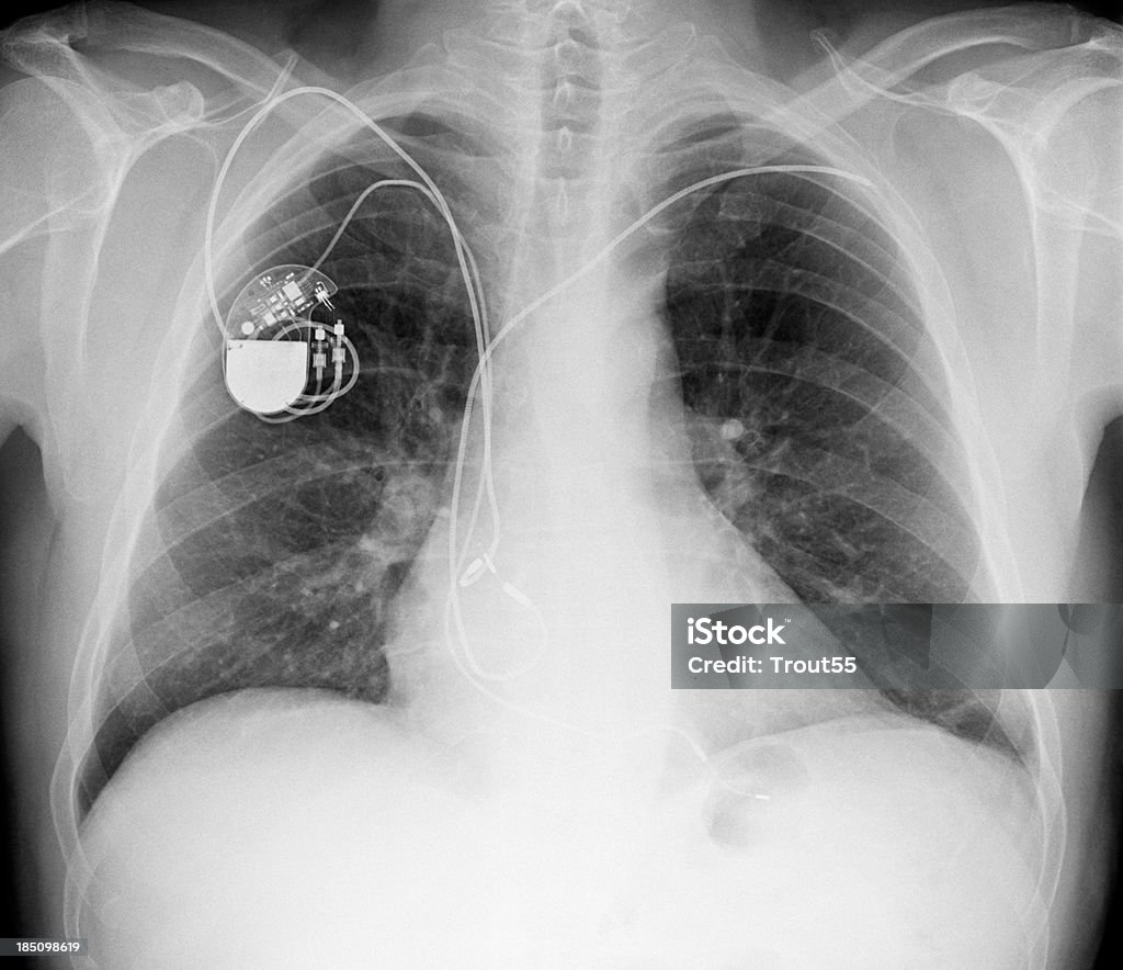 X-ray foto do peito com um marcapasso - Foto de stock de Marcapasso - Equipamento técnico médico royalty-free