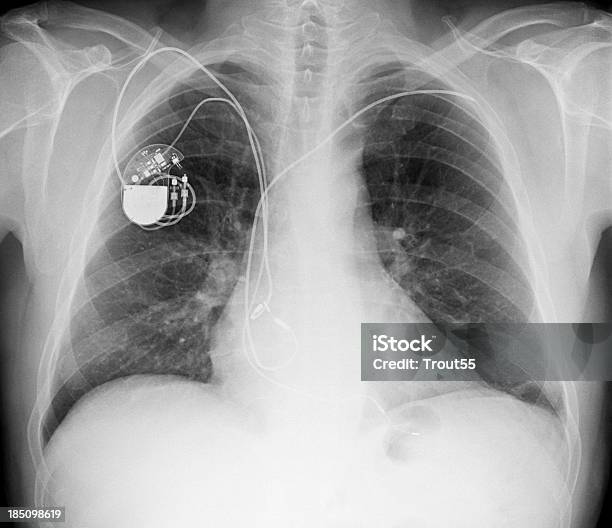 Foto de Xray Foto Do Peito Com Um Marcapasso e mais fotos de stock de Marcapasso - Equipamento técnico médico - Marcapasso - Equipamento técnico médico, Imagem de raios X, Pessoas