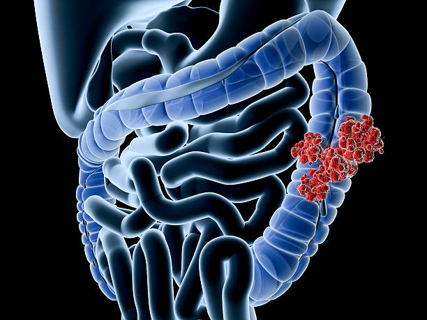 Colon cancer "Digital medical illustration: Perspective x-ray view of human colon with tumor. Anatomically correct. Isolated on black.For other cancer related-and general anatomy images, see:" human intestine stock pictures, royalty-free photos & images