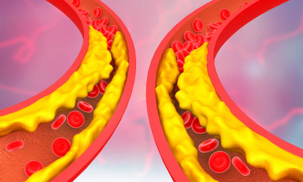 istock Clogged arteries on scientific background 1851611588