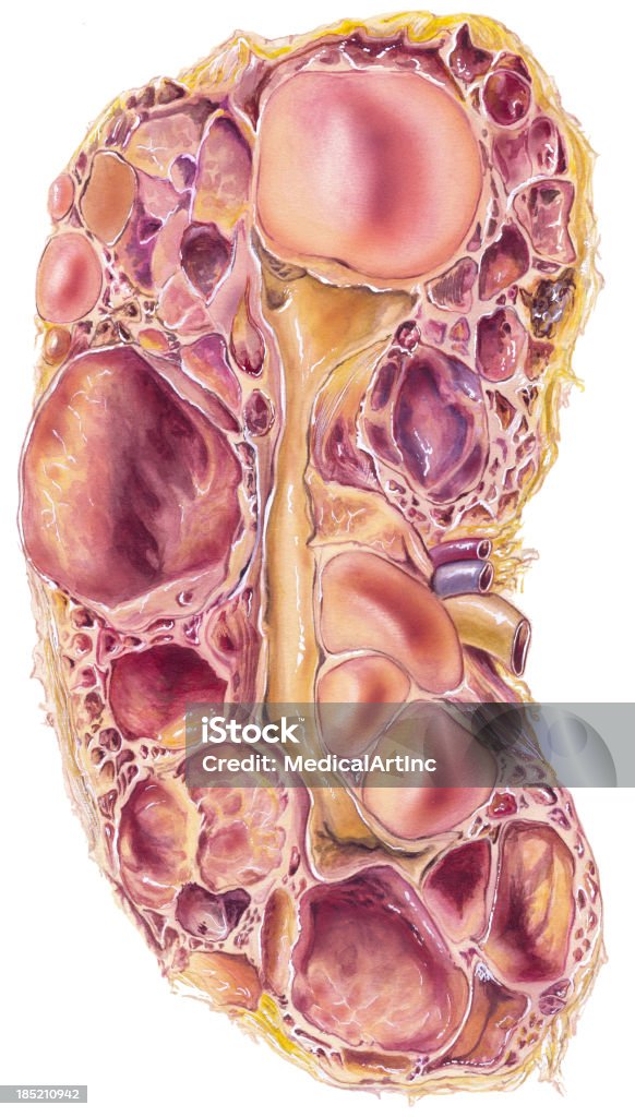 腎臓-Polycystic ディジース - ネフロパシーのロイヤリティフリーストックイラストレーション
