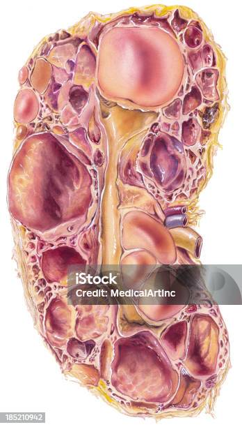 腎臓polycystic ディジース - ネフロパシーのベクターアート素材や画像を多数ご用意 - ネフロパシー, 腎障害, 病気
