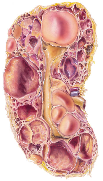 Kidney - Polycystic  Disease Autosomal-dominant polycystic kidney disease, or ADPKD, is a disorder passed down through families in which many cysts form in the kidneys, causing them to become enlarged. It is characterized by the proliferation of cysts that eventually debilitate the kidneys, causing kidney failure in half of all patients by the time they reach age 50. kidney failure stock illustrations