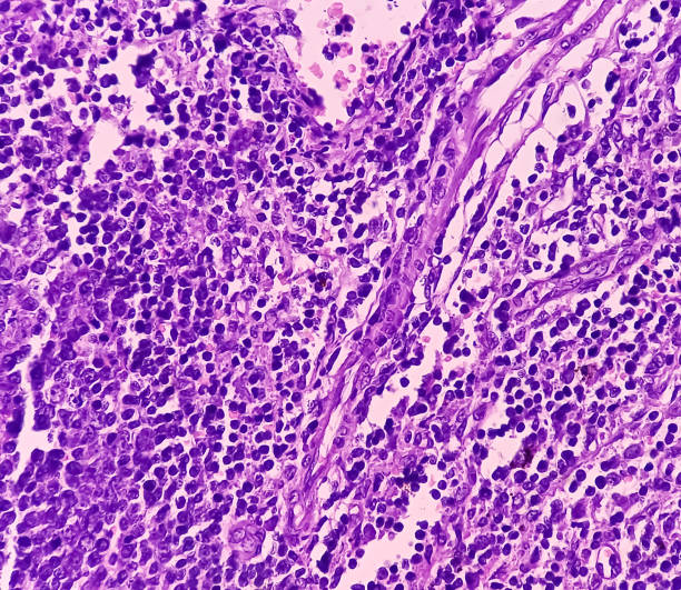 istock Thyroid cancer: Microscopic image of Metastatic papillary carcinoma of thyroid. Reactive change. Lymph node carcinoma. 1852158377