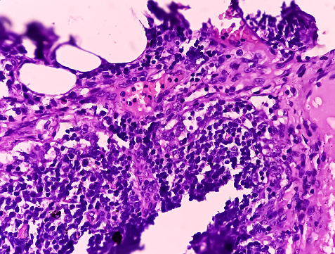 Thyroid cancer: Microscopic image of Metastatic papillary carcinoma of thyroid. Reactive change. Lymph node carcinoma.