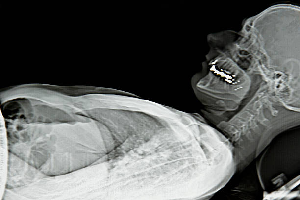 raio-x lateral da parte superior do corpo - human upper body xray imagens e fotografias de stock