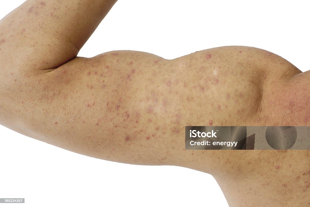 acne em um macho e o ombro do braço - Foto de stock de Acne royalty-free